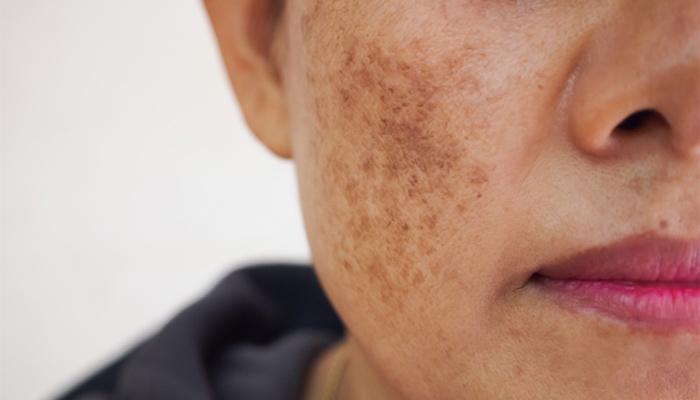 Melasma