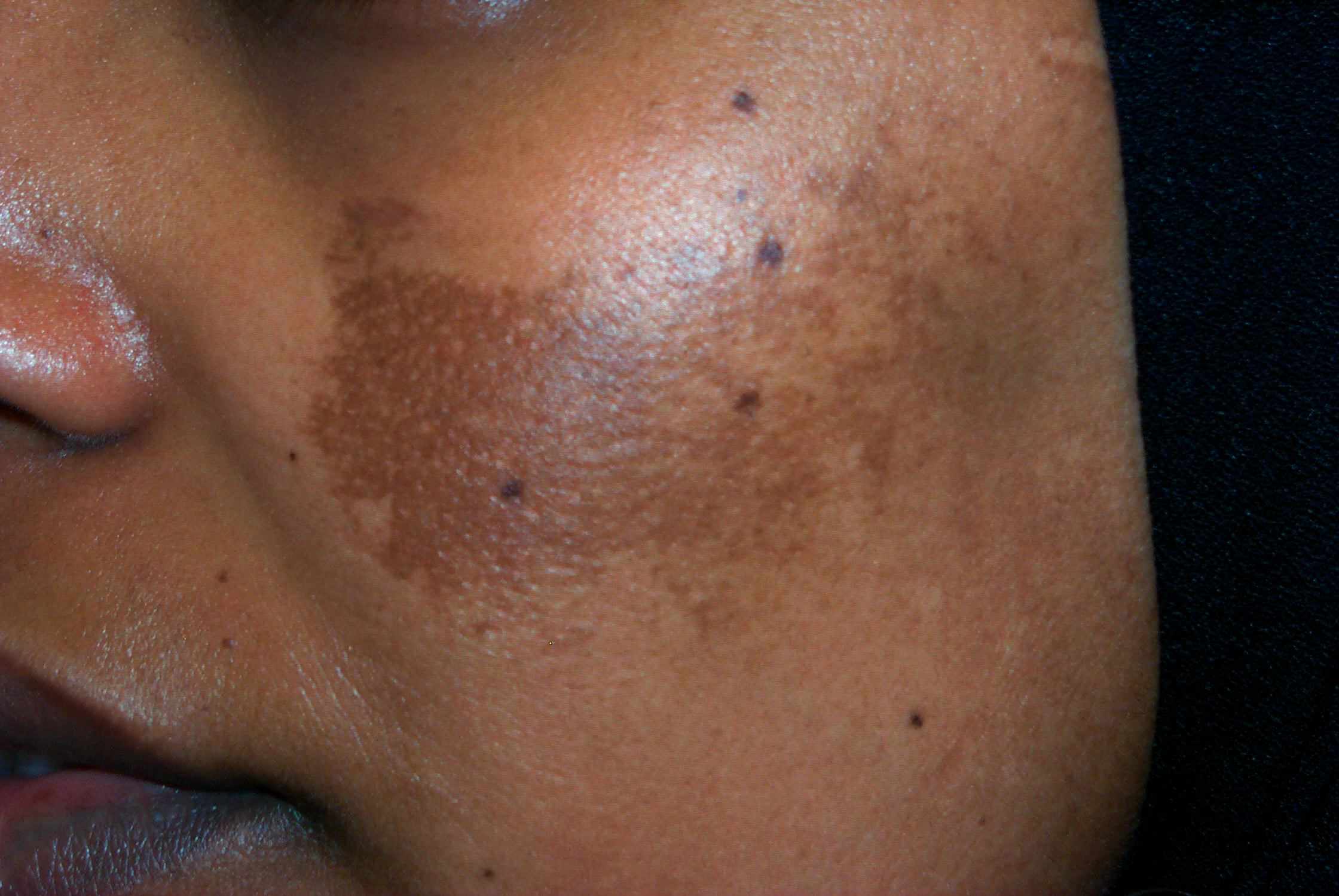 melasma piel negra