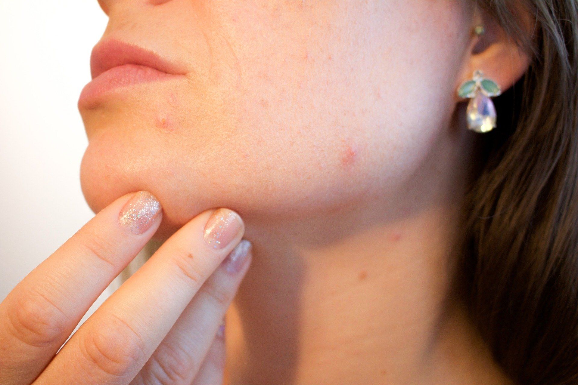 acne 1606765 1920