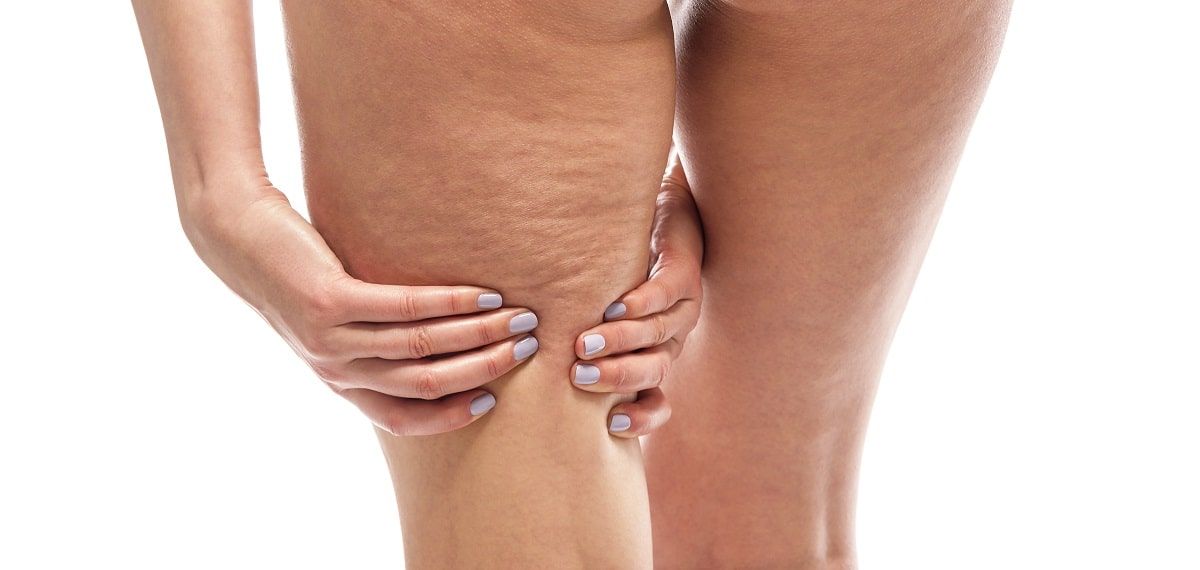 celulitis pierna