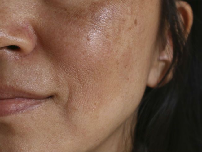melasma facial p