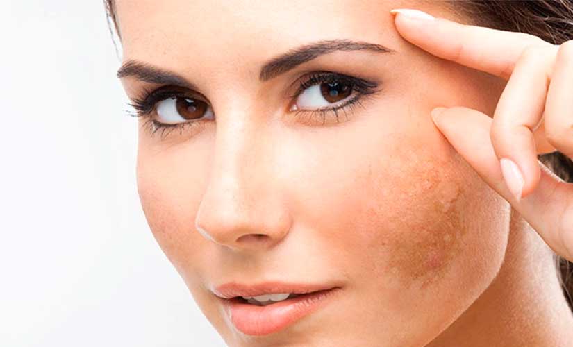 melasma post