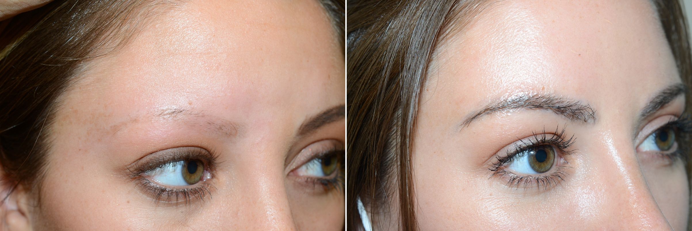 trasplante de cejas 
