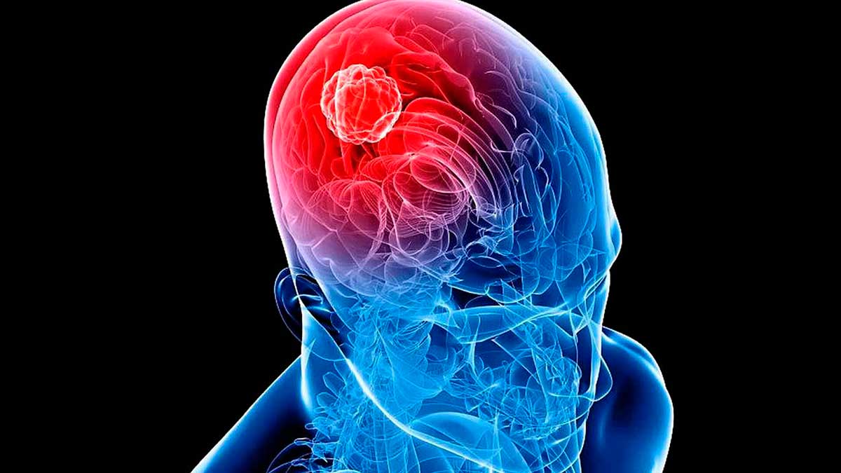 Tumores cerebrales benignos, conoce sobre esta afección 2 tumor cerebral 1