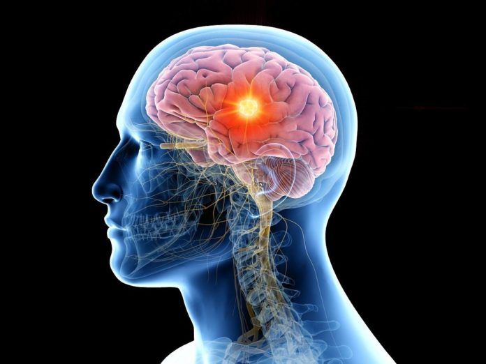 Tumores cerebrales benignos