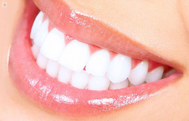 Diseno de sonrisa