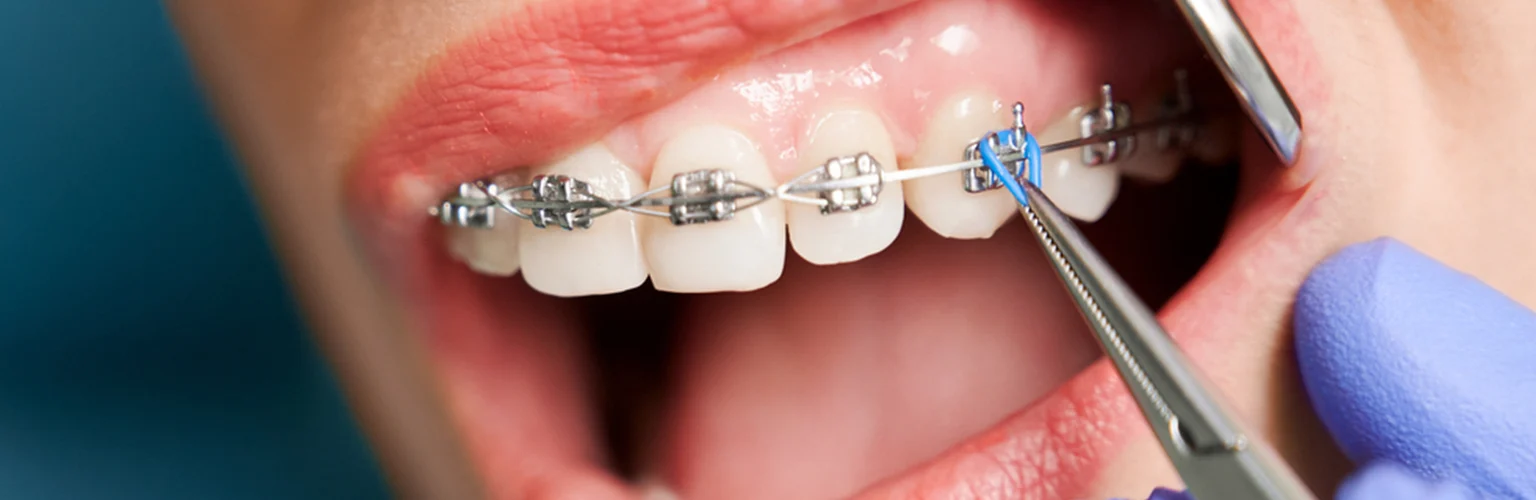 Brackets