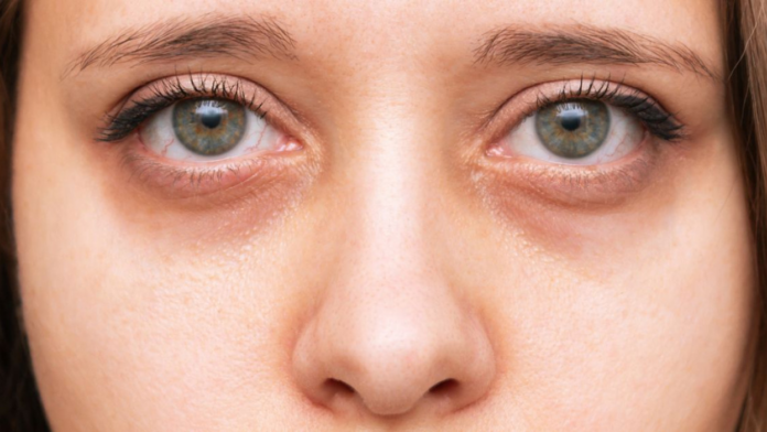 Ojeras