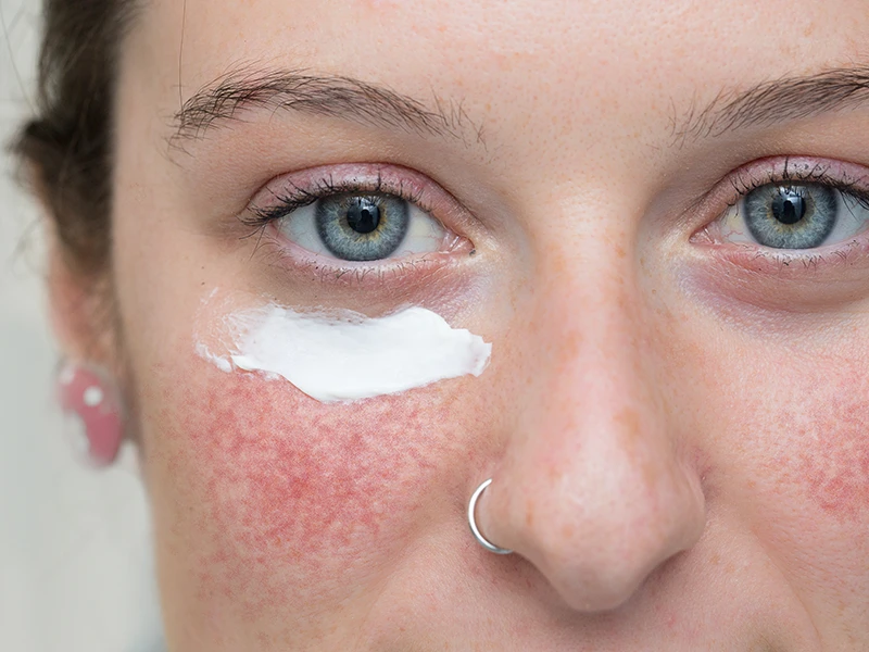 Los 10 errores más comunes en el cuidado de la piel que debemos evitar 7 6 CLAVES MAQUILLARTE CON ROSACEA