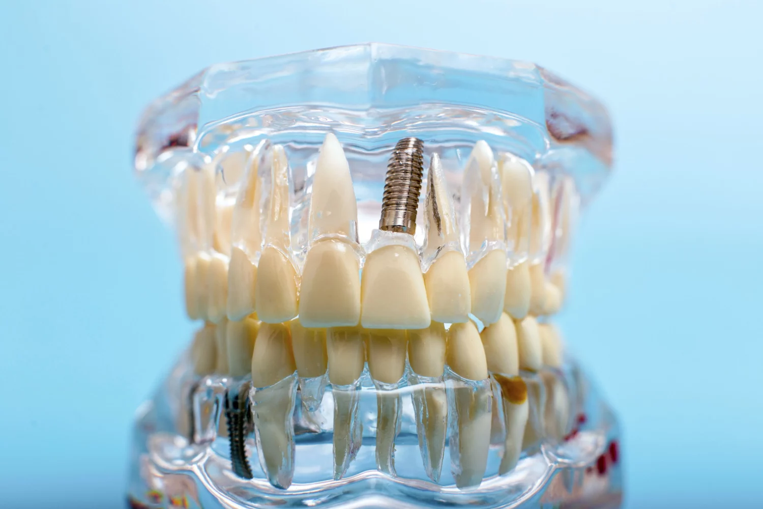 Armonización facial y Armonización orofacial: Belleza en equilibrio 9 6585477e177e3a4e88450046 que son implantes dentales y como funcionan clinica dental mingari toledo
