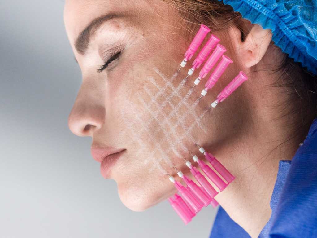 Armonización facial y Armonización orofacial: Belleza en equilibrio 5 hilos pdo