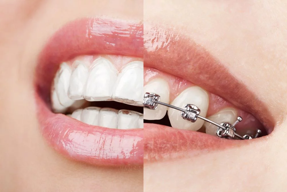 Armonización facial y Armonización orofacial: Belleza en equilibrio 8 invisalign brackets.jpg